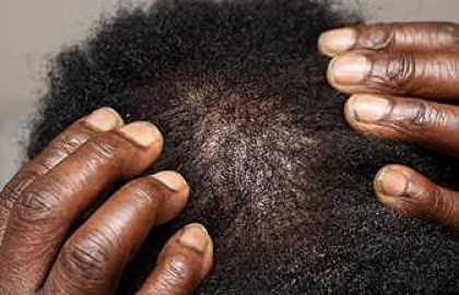 Alopecia Areata Explained: Signs, Oils That Help, and How to Regrow Hair
